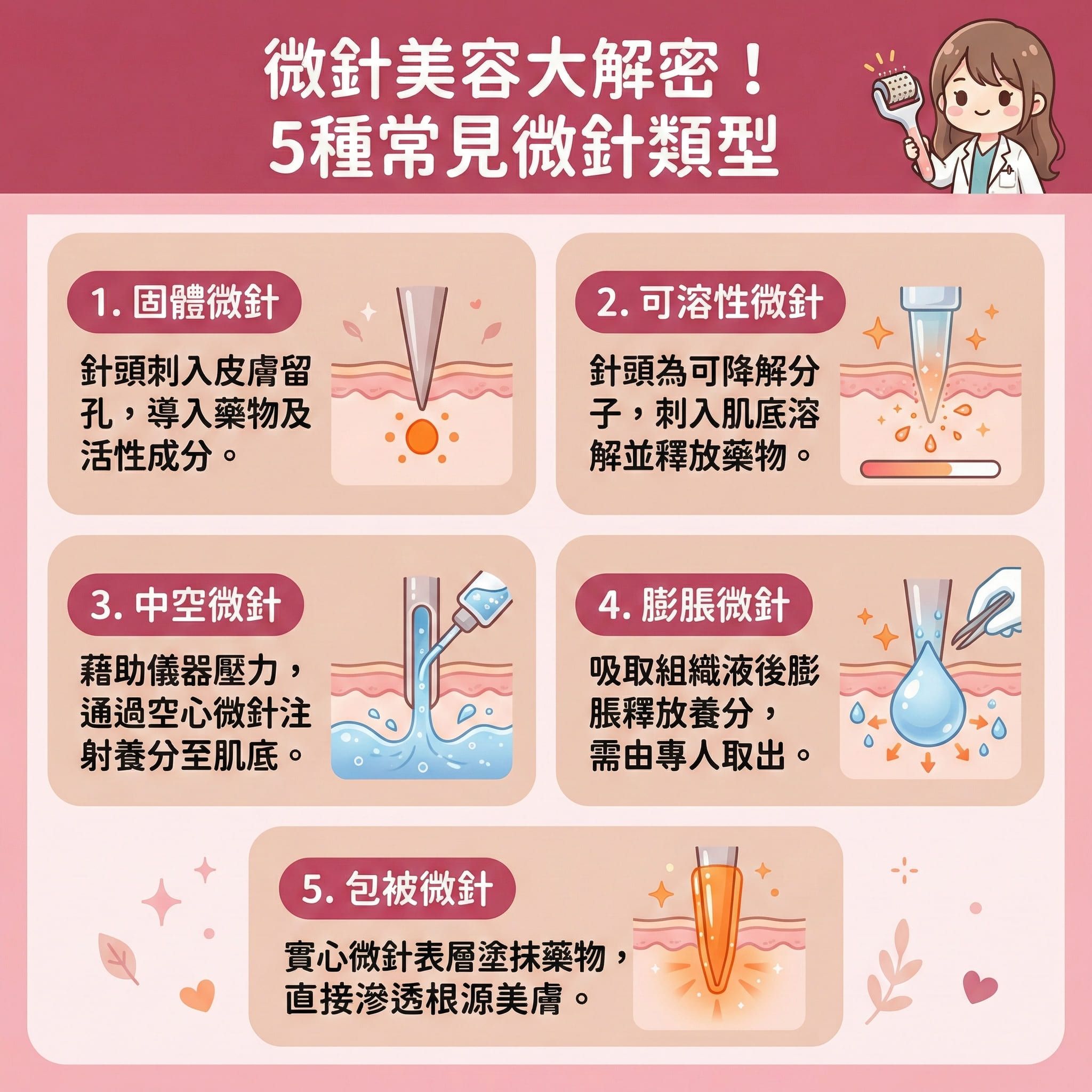 這是一張正方形扁平化的台灣健康部落格風格資訊圖表，詳細介紹微針與射頻微針的5大類型。圖表說明這種微創治療能穿透角質層與表皮層，直達真皮層。透過微針滾輪或專業儀器，能導入精華（如玻尿酸與專屬精華液），有效刺激血液循環與促進新陳代謝。

療程透過微小創口來修復受損組織，喚醒膠原蛋白與彈性纖維，不僅能刺激膠原增生，更能促進細胞更新。臨床證明能有效對抗凹凸洞與疤痕，達到撫平凹凸洞的效果；針對暗瘡印與黑色素，能減淡暗瘡印及改善色素沉澱。同時幫助清理毛孔，達到收細毛孔、緊緻肌膚、改善粗糙、提升彈性與提亮膚色的全面升級。

圖表提醒，為縮短恢復期及預防發炎，術前可由專業人士塗抹麻醉膏，術後需嚴格注重保濕並避免日曬，以舒緩紅腫。建議尋求皮膚科醫生或合規美容院協助，切勿自行操作。圖表最後強烈推薦體驗完美醫療的專業暗瘡分手療程，安全還原健康平滑肌。