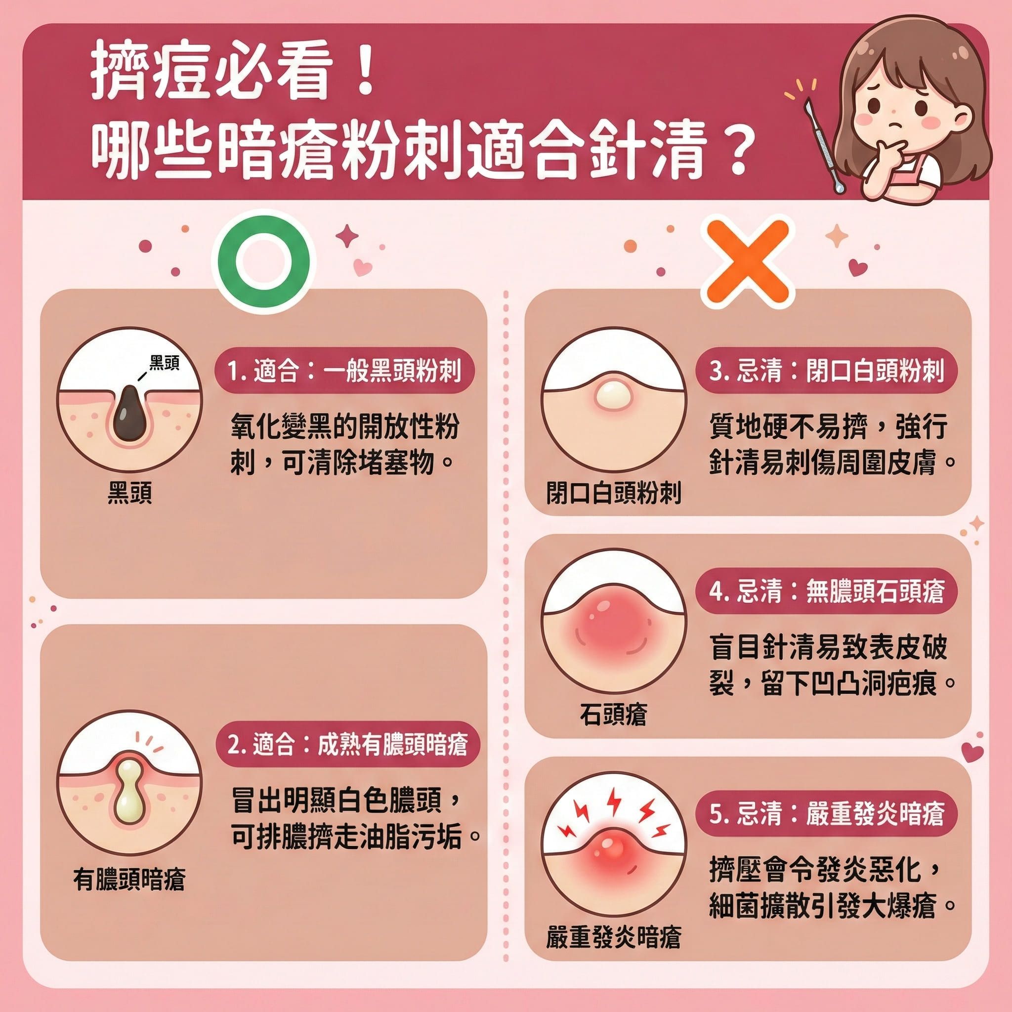 這是一張正方形扁平化醫學美容資訊圖表，教導大家針清的正確用法與時機。圖表指出，若皮脂腺分泌過盛導致毛孔堵塞，形成一般黑頭或帶有成熟膿頭的暗瘡，可透過深層清潔與疏通毛孔來處理。進行前務必用消毒火酒或酒精為暗瘡針進行徹底消毒，並先溫和潔面及軟化角質，再輕輕擠壓以清除污垢。

圖表警告，針對閉口粉刺、發炎暗瘡或石頭瘡，切勿自行針清以避免發炎。強行擠壓會損壞角質層，引發細菌擴散，極易留下暗瘡印與凹凸洞。建議尋求美容院的美容師或皮膚科醫生作專業評估。療程後需注重鎮靜肌膚、舒緩紅腫並修復皮膚屏障以預防留疤。

日常護理可配合果酸換膚與激光治療來抑制油脂分泌、收細毛孔及刺激膠原增生。圖表強烈推薦體驗完美醫療的專業暗瘡分手療程，達致無痛清痘與改善粗糙膚質，從根源長效預防復發，重拾平滑健康肌膚。